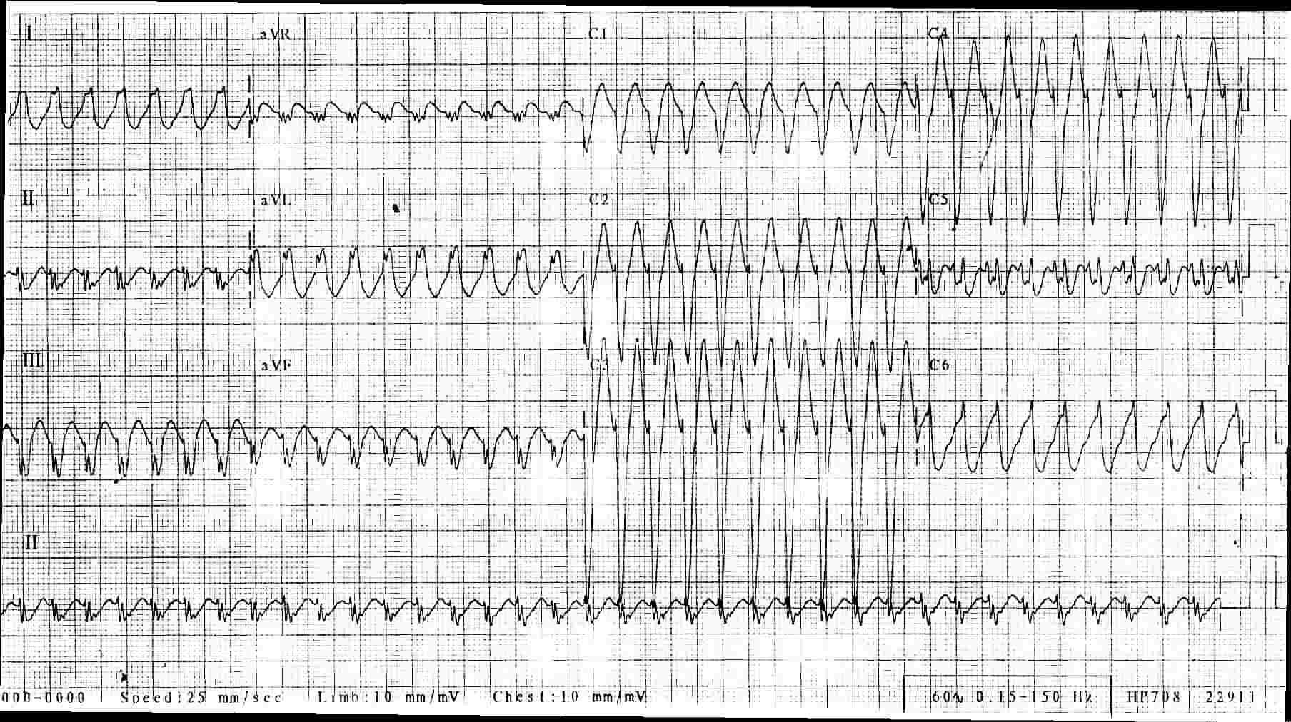 Wide Complex Tachycardia ECG Guru Instructor Resources